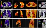 氙气增强通气 CT 在放疗期间保护肺部