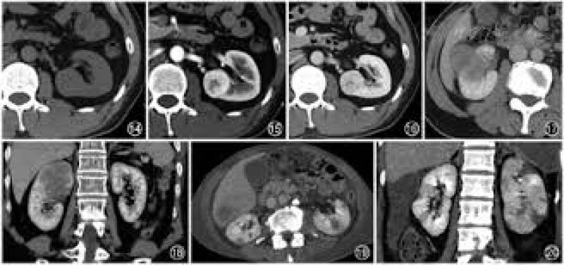 新兴的 PET/CT 成像剂显示出诊断透明细胞肾细胞癌的前景