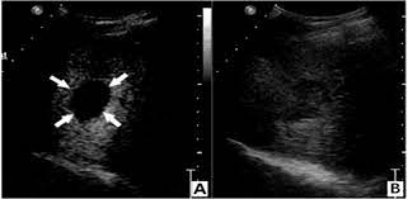  全氟丁烷造影增强超声能否为诊断肝细胞癌提供可行的选择？