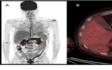 案例研究:FDG PET/CT发现胰腺炎与新冠肺炎有关