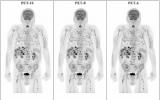 全身PET/CT缩短了黑色素瘤患者的扫描时间