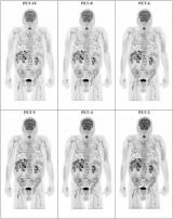 全身PET/CT缩短了黑色素瘤患者的扫描时间