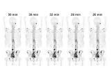 快速采集技术将SPECT/CT骨骼扫描时间缩短了一半