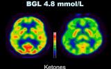 生酮饮食会影响脑PET成像吗？