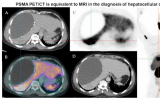 PSMA-PET 在肝癌诊断方面与MRI相当，优于CT