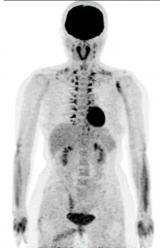 PET/CT显像中的假象——棕色脂肪显影