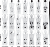 新型PET放射性示踪剂成功检测出多种癌症，为新的靶向放射性核素治疗提供了潜力
