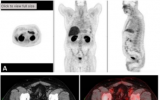 新兴PET放射性示踪剂在检测前列腺癌方面显示多种优势