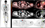FDG-PET/CT扫描可显示罕见的神经结节病