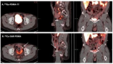 新兴的PSMA PET试剂可能改善前列腺癌的检测