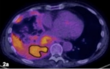 PET/CT提高了肺癌患者的活检诊断准确性