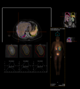 Telix与ABX-CRO合作开发放射药物治疗个性化剂量测定QDOSE®平台