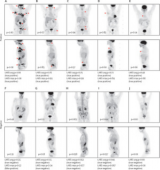 长达数年的研究指出淋巴瘤深度学习PET成像模型的临床潜力