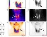 ​核医学中的一种多功能同位素