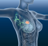 LumiSystem或助乳腺癌患者减少放疗范围