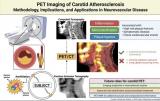 PET成像技术在颈动脉斑块评估中展现应用前景