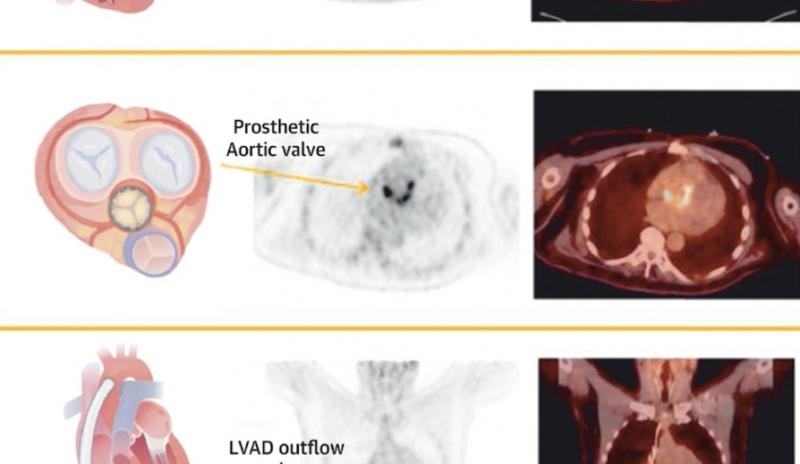 核医学心脏病学迈向新时代：超越灌注成像，拓展疾病诊断边界