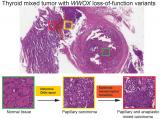 研究发现WWOX基因胚系失活突变促进甲状腺癌发生发展新机制