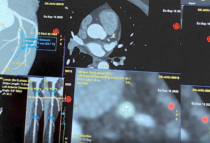 CCTA技术发展迅猛 推动冠状动脉疾病精准诊疗