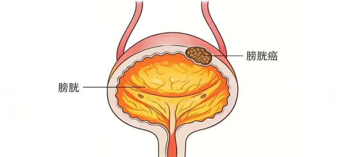 PET/CT在膀胱癌诊断中的应用