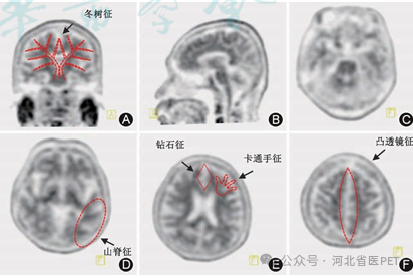 精准“探脑”，助力阿尔茨海默病诊疗——核医学科成功开展Aβ-PET/CT脑显像检查