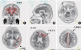 精准“探脑”，助力阿尔茨海默病诊疗——核医学科成功开展Aβ-PET/CT脑显像检查
