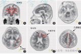 精准“探脑”，助力阿尔茨海默病诊疗——核医学科成功开展Aβ-PET/CT脑显像检查