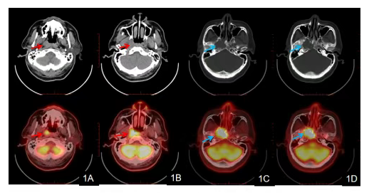核医学显像技术为耳鼻喉头颈外科疾病诊疗提供关键功能影像
