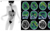 核医学技术拓展应用边界 FDG PET/CT首次揭示狂犬病脑炎脑代谢图谱