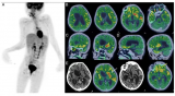 核医学技术拓展应用边界 FDG PET/CT首次揭示狂犬病脑炎脑代谢图谱