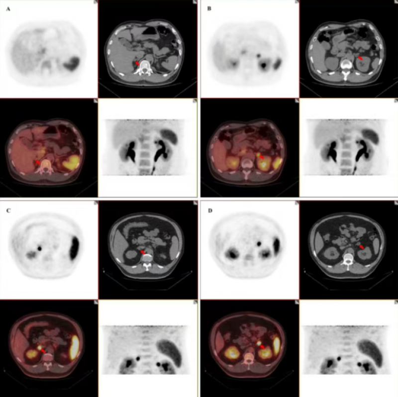 新型靶向放射性药物68Ga-pentixafor革新内分泌疾病手术决策
