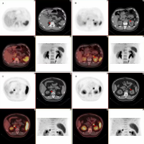 新型靶向放射性药物68Ga-pentixafor革新内分泌疾病手术决策