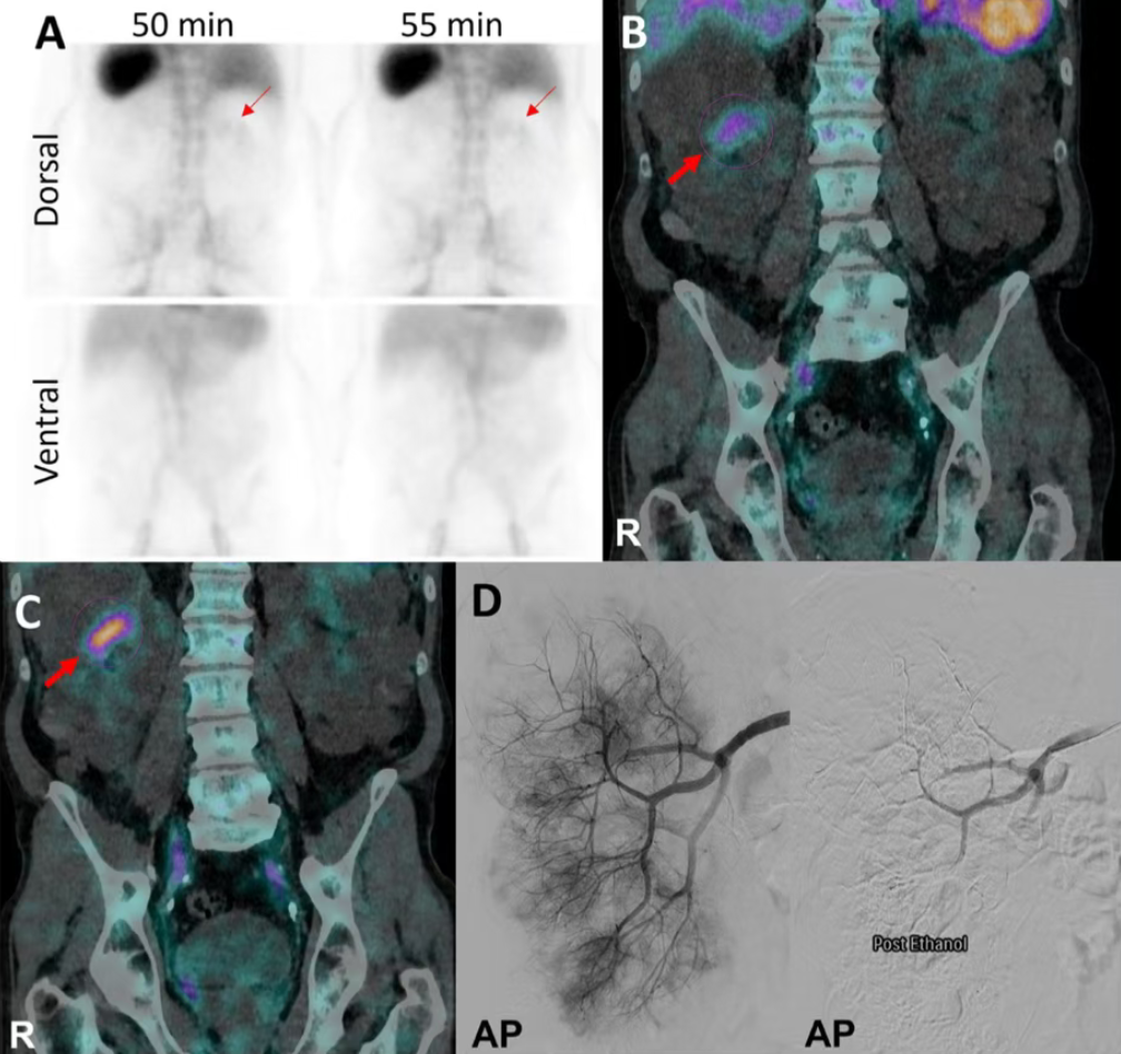 核医学功能显像突破解剖局限：锝-99m红细胞示踪技术精准锁定复杂结构出血病灶