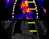 核医学功能影像实现突破：F-18 PET/CT技术首次动态量化透析患者血管钙化活性
