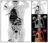 核医学功能影像突破：“热性胸膜”PET/CT显像拓宽罕见肿瘤诊断路径