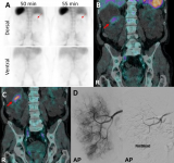 核医学功能显像突破解剖局限：锝-99m红细胞示踪技术精准锁定复杂结构出血病灶