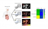 JNM最新研究：⁶⁸Ga-FAPI-46 PET/CT显著提升胃肠道间质瘤诊断精准度