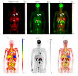全球首例同日双核素PET成像实现 核医学技术突破助力肿瘤精准诊疗
