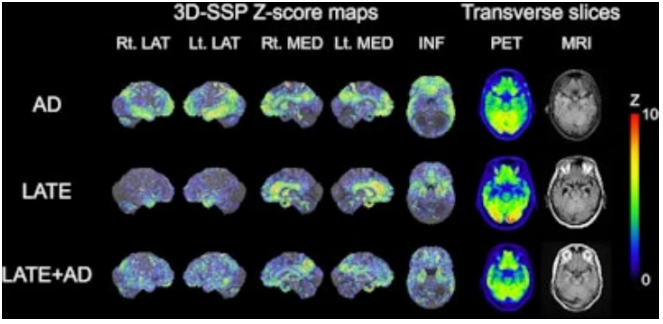 核医学学会报告：新型PET定量方法有望实现痴呆症精准鉴别