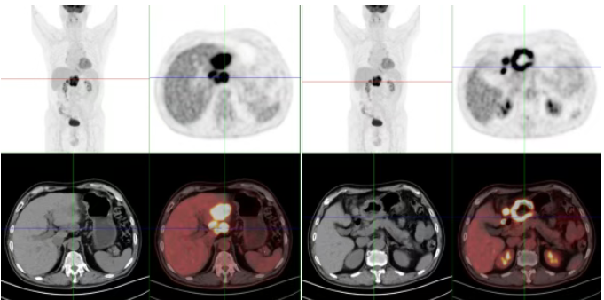 在消化道肿瘤检查中，PET/CT能提供这些关键信息