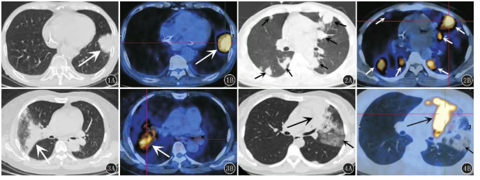 18F-FDG PET/CT在肺部MALT淋巴瘤诊断与疗效评估中的价值分析