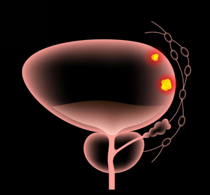 靶向α核素疗法新进展：Ac-225标记药物AKY-1189获FDA快速通道资格