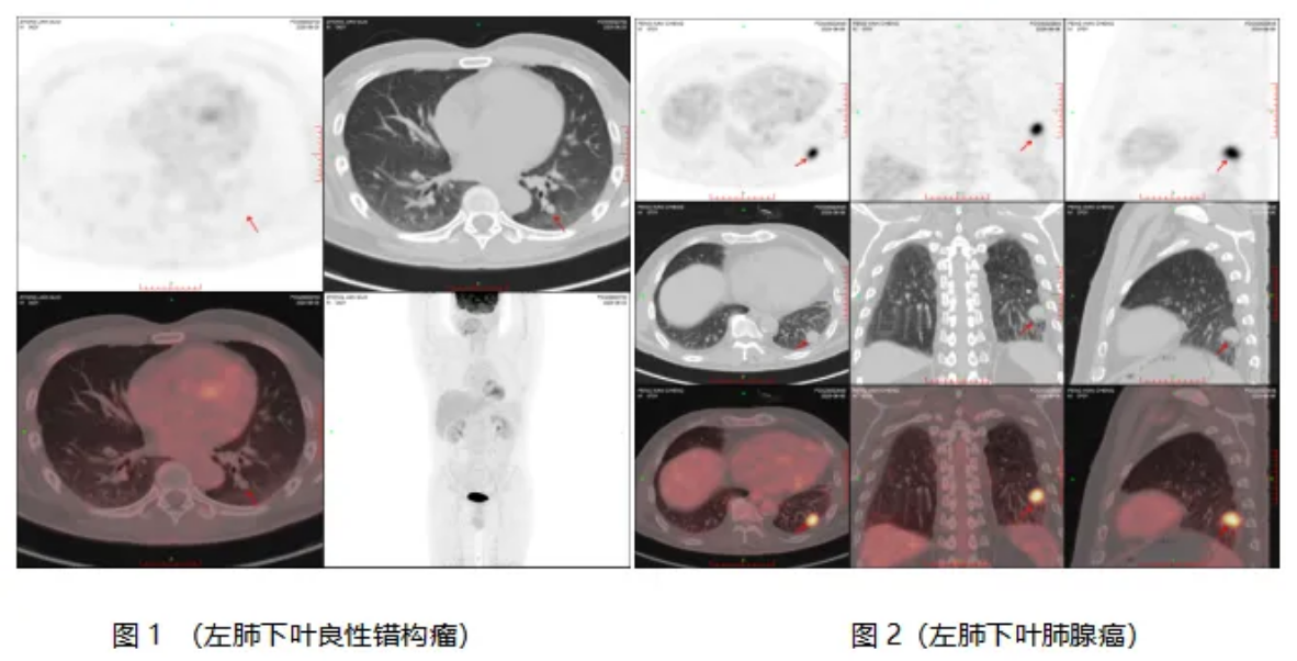 PET/CT在肿瘤诊疗中的四大关键作用解析