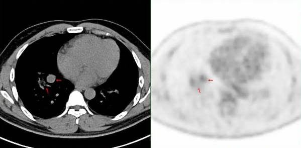 18F-FDG PET/CT显像助力诊断“特发性肺含铁血黄素沉着症” 