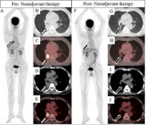 广东省人民医院核医学科邵丹团队PET/CT预测肺癌新辅助免疫治疗疗效获新突破