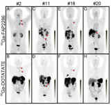 双靶点精准打击：新型“鸡尾酒”核素疗法为难治性神经内分泌肿瘤带来新希望