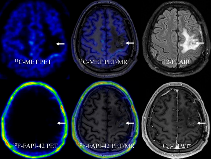 新型示踪剂18F-FAPI-42 PET/MRI在胶质瘤术后复查中展现卓越诊断价值