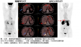 河北人民医院推出靶向GPC3 PET/CT检查 助力肝癌精准诊疗