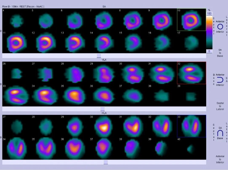 北京核工业医院成功开展首例锝[99mTc]替曲膦心肌灌注显像