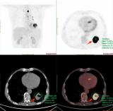 PET-CT一体显像精准锁定多原发肿瘤，为复杂病史患者提供全面病情评估